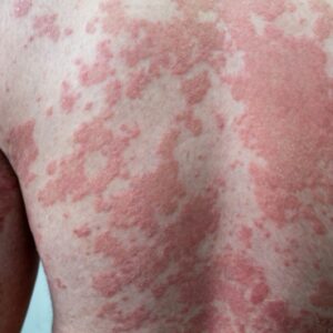 Image of a mans back showing the effects of Psoriasis